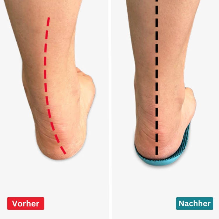 Fußeinlagen zur Schmerzlinderung | Hilft bei Plantarfasziitis & Neuropathie